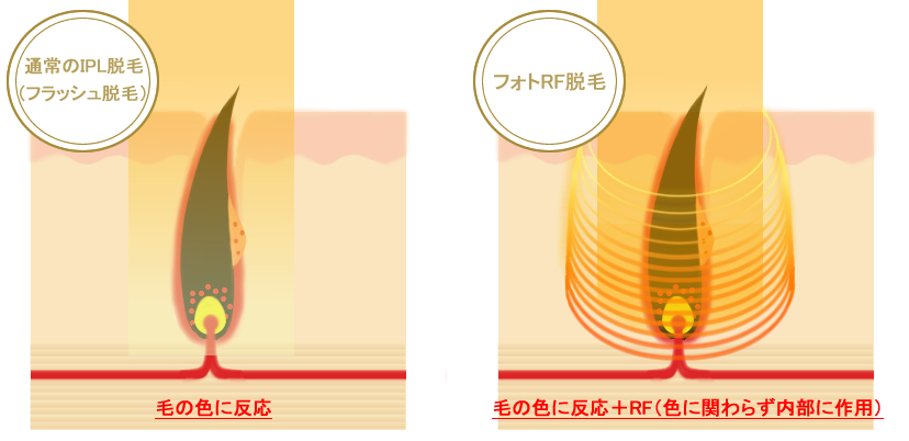 絶対役に立つ フラッシュ脱毛 の基礎知識 ゆるダツ 絶対役に立つ フラッシュ脱毛 の基礎知識 ゆるダツ