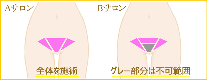 脱毛サロンにおけるVIOラインの施術範囲の違いについて