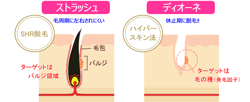 ストラッシュとディオーネの脱毛法