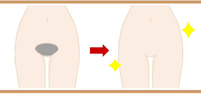 ハイジニーナ（VIO）脱毛とは